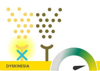 Illustration of the effect of amantadine on glutamate hyperactivity through the NMDA receptor during dyskinesia.